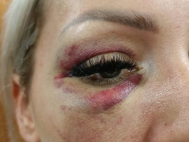 Dominika została brutalnie pobita. Kobieta nie chce już milczeć o miłości zamienionej w koszmar